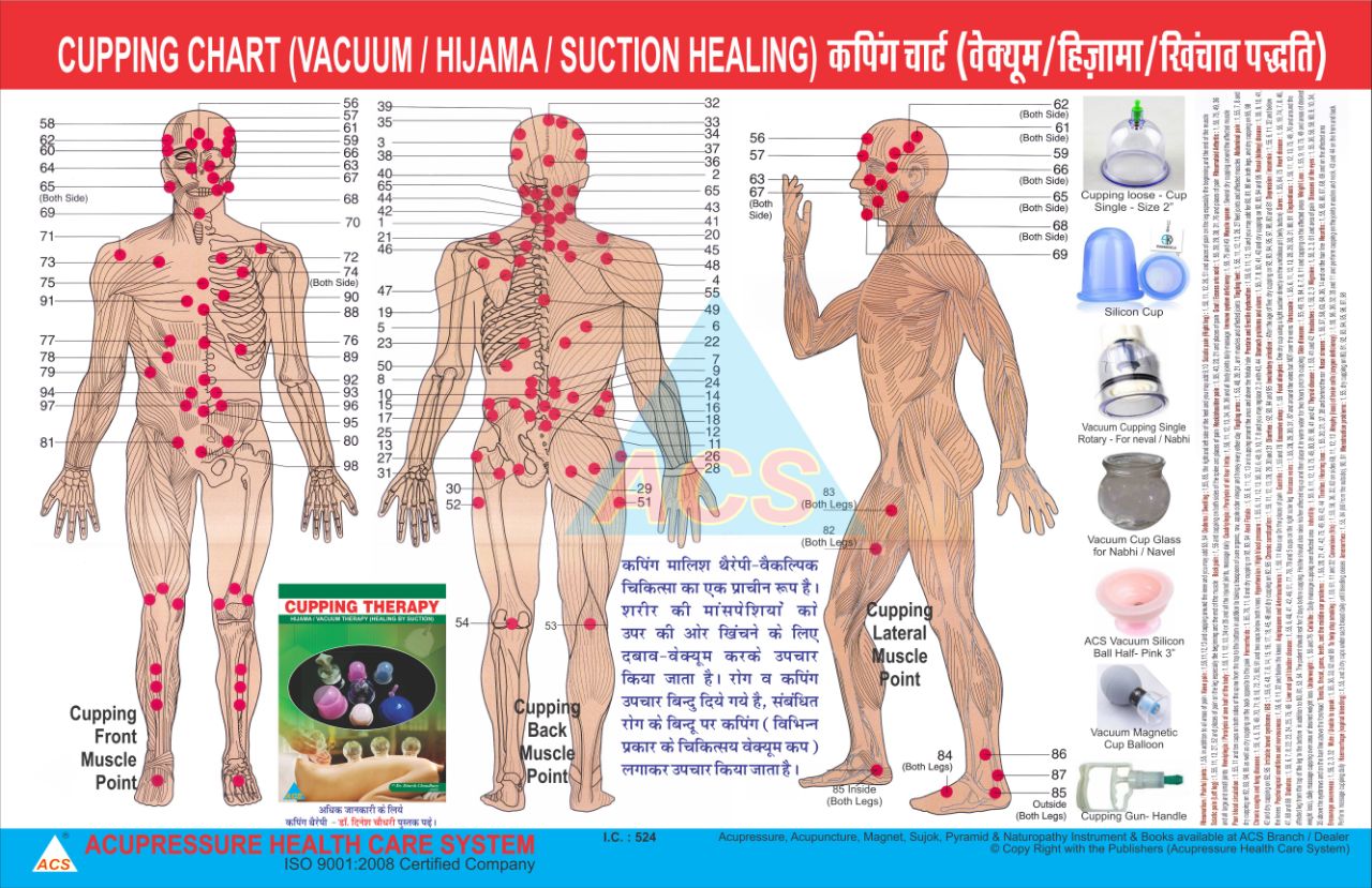 ACS Cupping Therapy Chart -  Hijama / Vacuum 