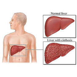 Disease of the Liver 