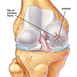 Oste-Arthritis 