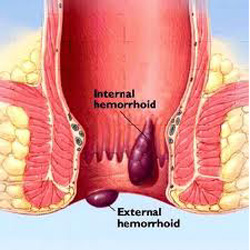 Piles-Hemorrhoids 