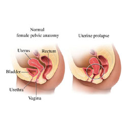 Prolapsed Uterus 