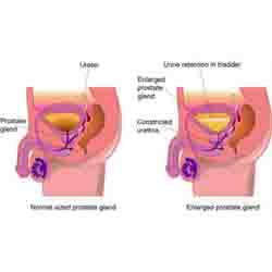 Enlarged Prostate Gland 