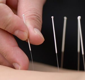Diploma in Acupuncture (D.Ac.) Level - I 