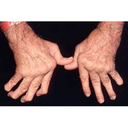 Rheumatic Arthritis  - 0 