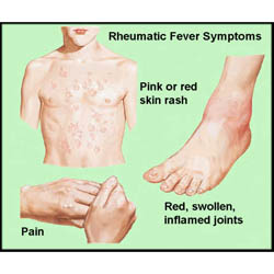 Rheumatic Fever  -  