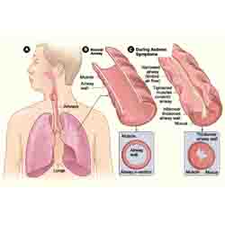 Asthma  -  