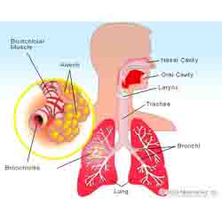 Bronchitis  -  
