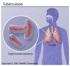 Tuberculosis  -  