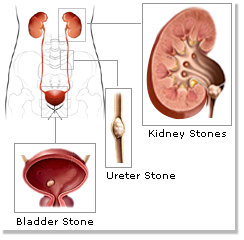 Kidney Stone  -  